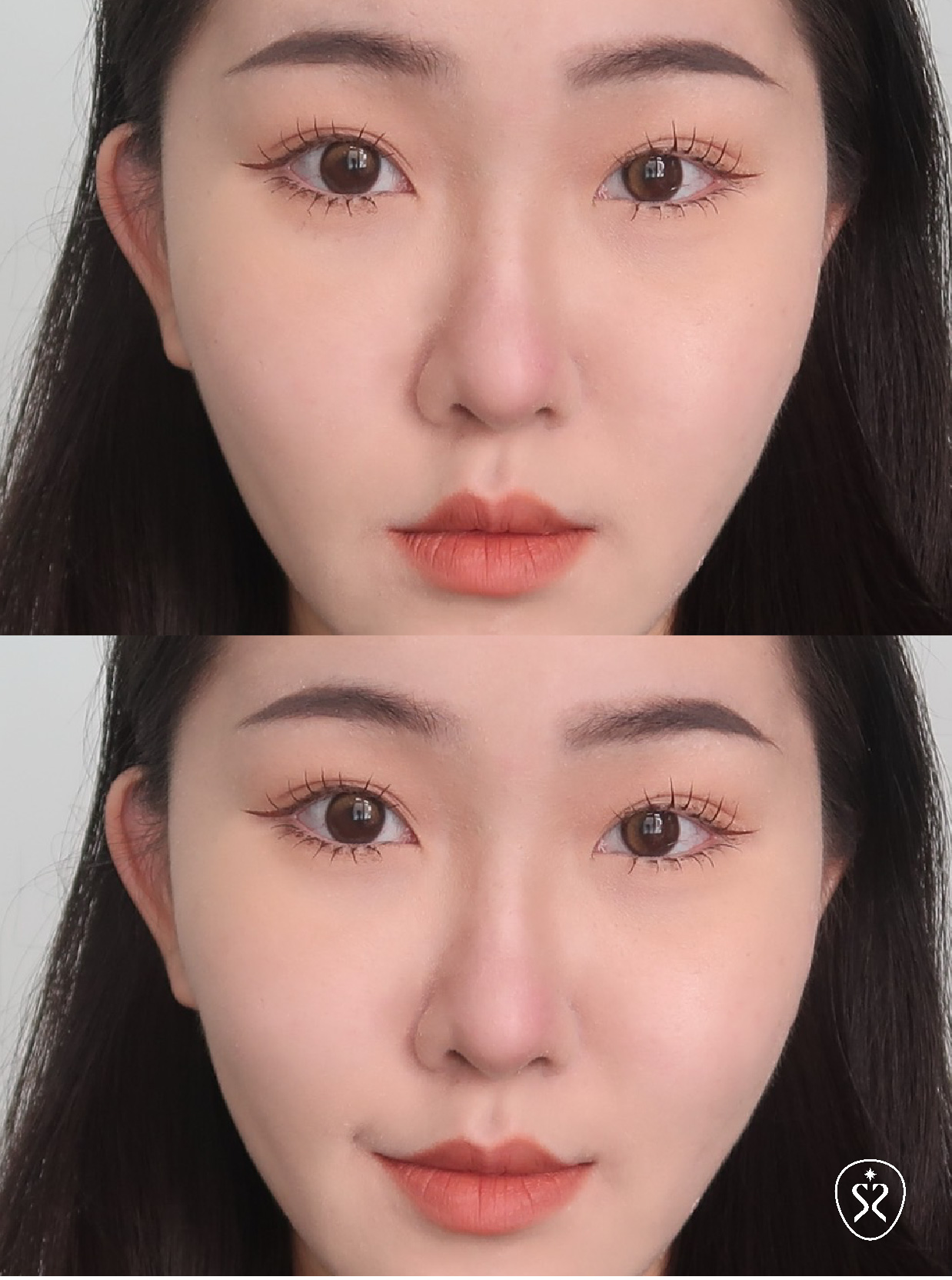 術後的修復期因人而異,後續的保養可不能少喔